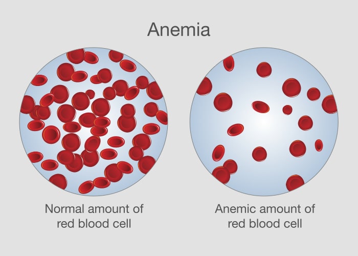 ferrytyna a anemia